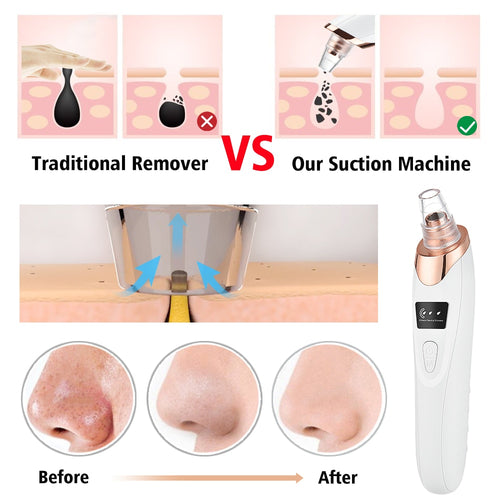 Aspirateur Points Noirs Électrique – Nettoyant Pores & Exfoliant Visage | Vélyra